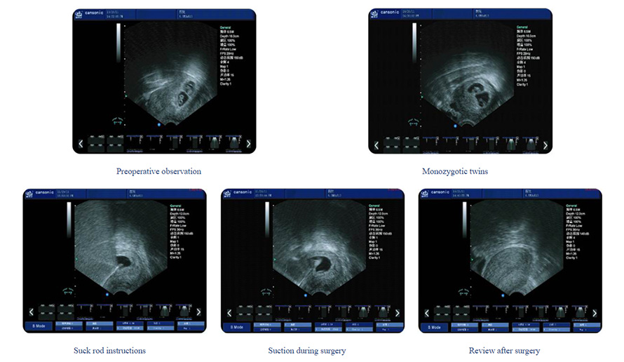 Intrauterine Ultrasound Guidance System (600A-5)1